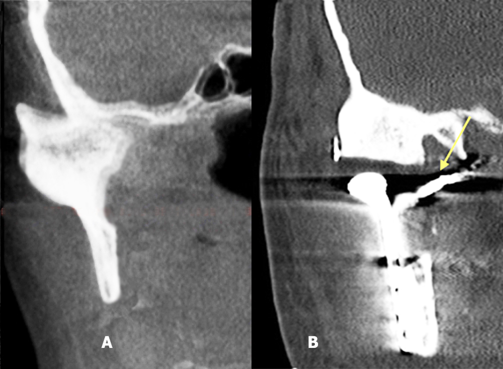 Before/after radiographs of TMJ total replacement device